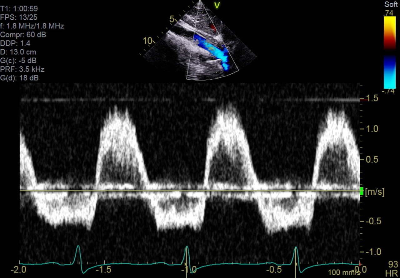 Flow reversal in aortic regurgitation